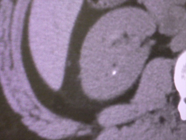 CT画像　腎結石2mm
