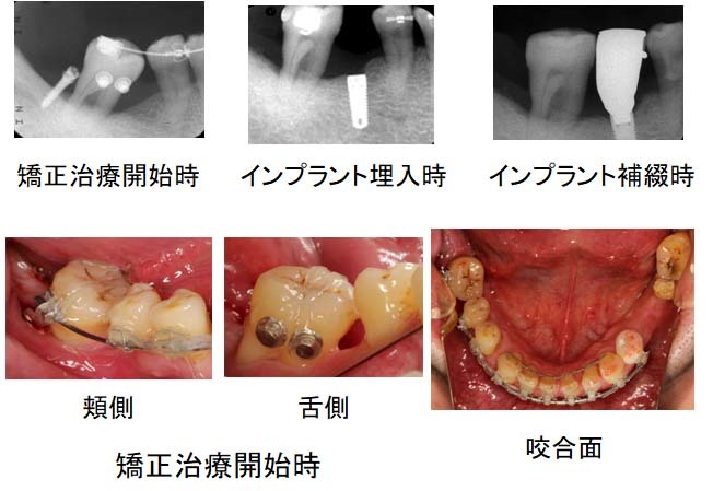 右下臼歯部の治療経過