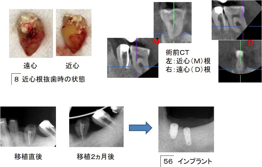 左下臼歯部の治療経過